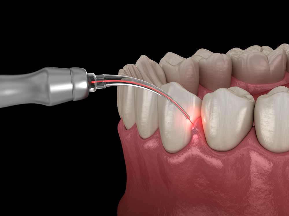 laser gum disease treatment