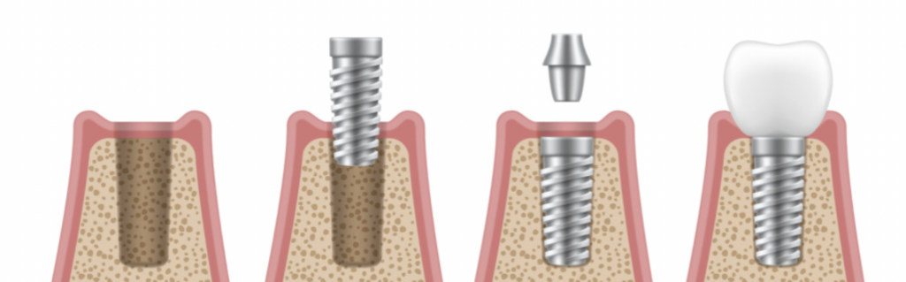 dental implants cost guide san antonio tx