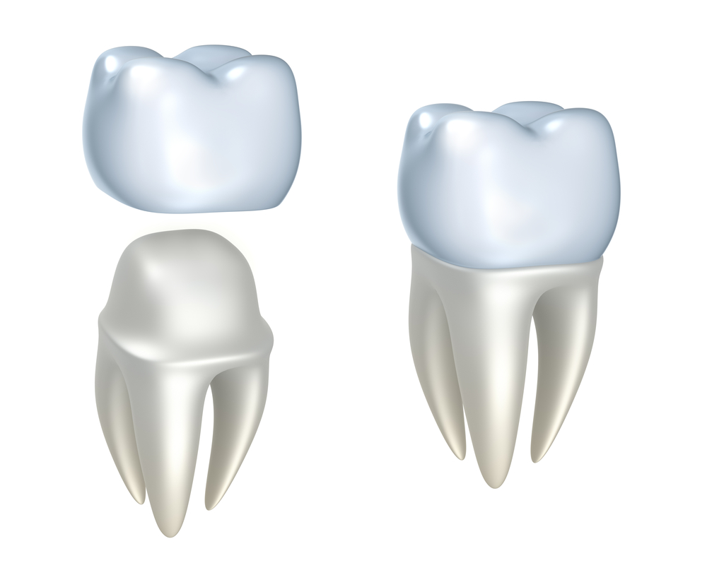 dental implants vs dental crowns