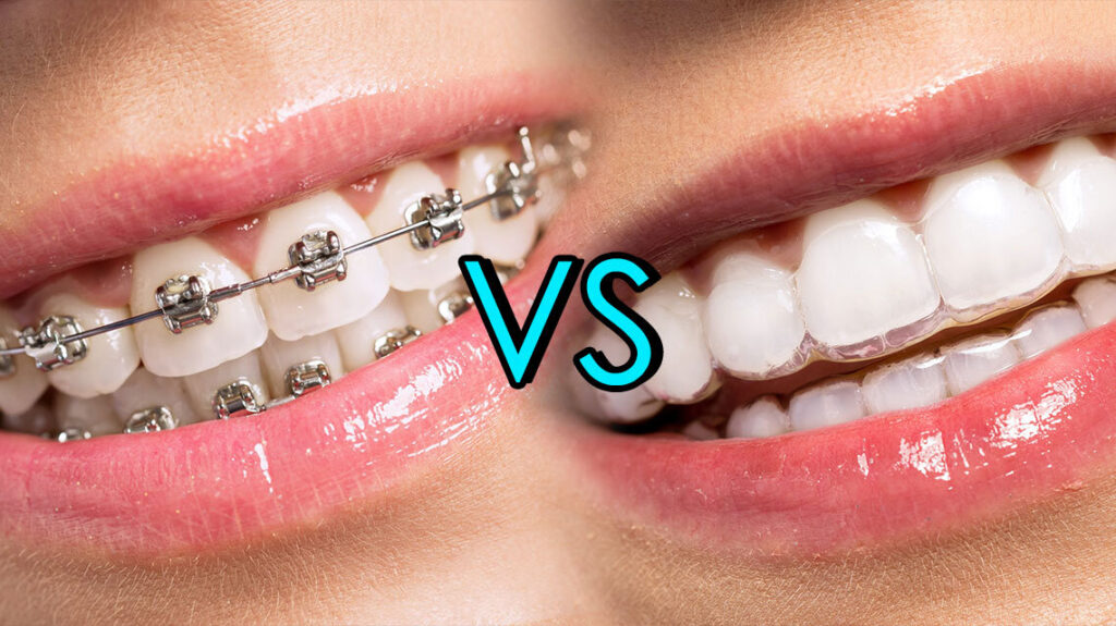 clear braces vs metal braces