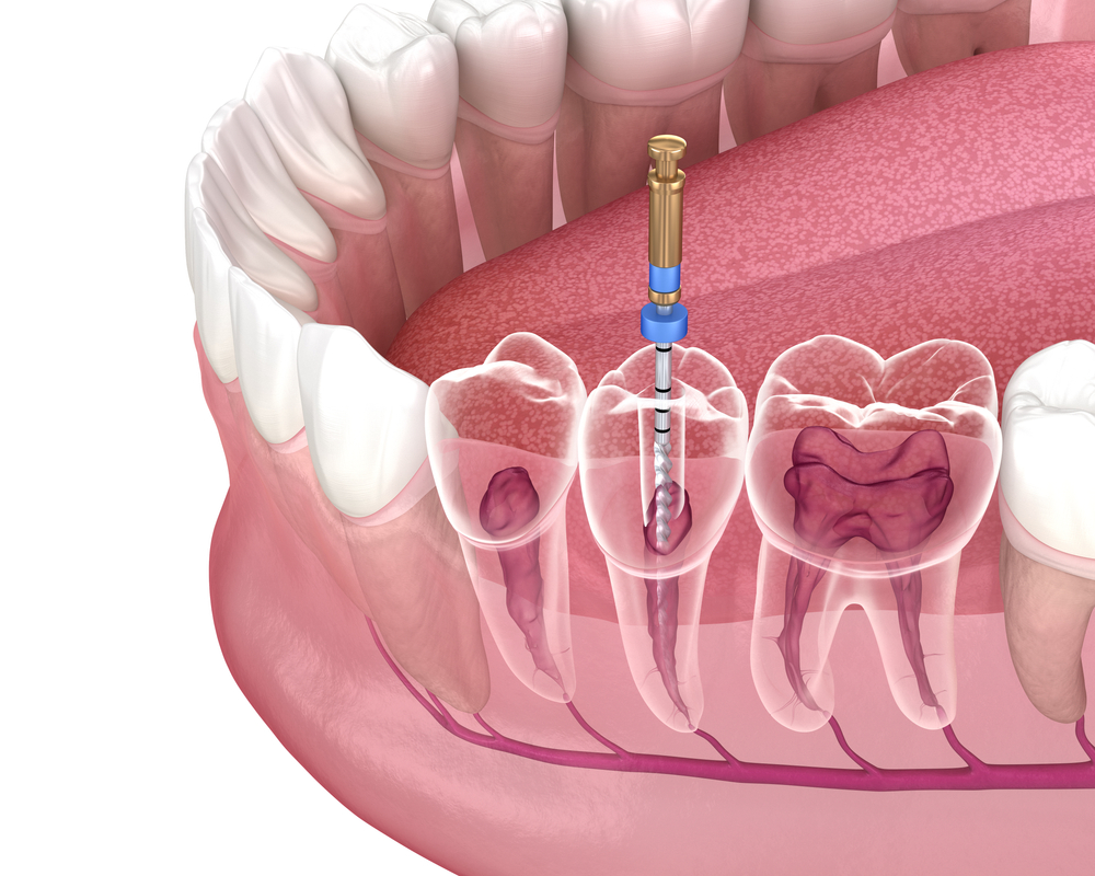 root canal treatment in san antonio tx