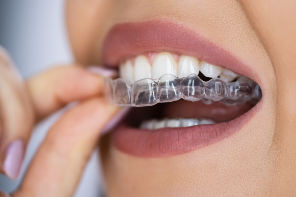 cost of invisalign in San Antonio tx