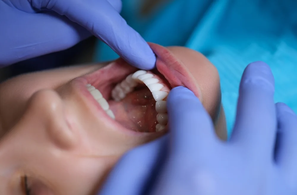 Understanding Composite Veneer Replacement