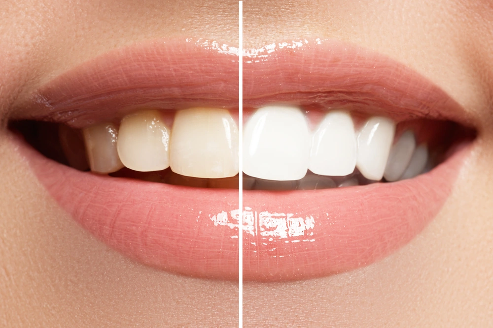 Take-Home Whitening Kits at Fountain of Youth Dental