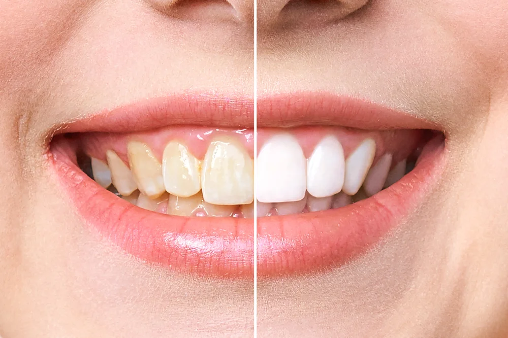 Teeth Bleach: Safety and Effectiveness