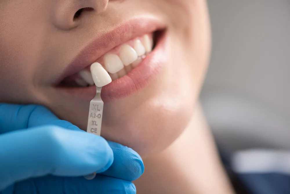 In-Office Teeth Whitening in San Antonio