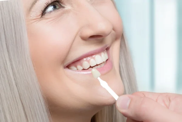 Aftercare for Veneer Teeth Near Me: Tips to Keep Your Smile Bright